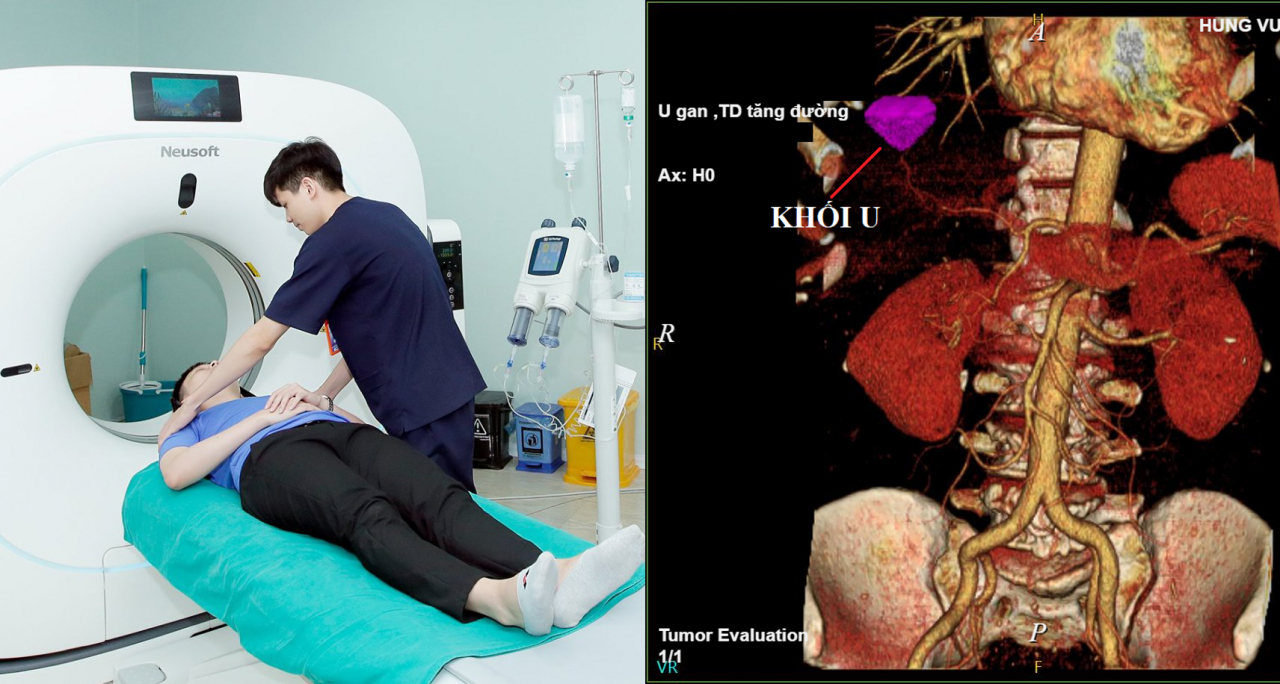 ung-thu-gan-o-tuoi-28-do-kinh-nghiem-10-nam-uong-ruou