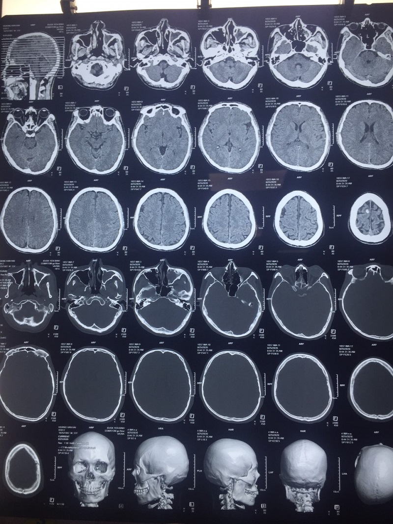 Hình ảnh chụp CT sọ não của bệnh nhân Hoàng Văn.H (Hình ảnh do bác sỹ Bệnh viện Đa khoa Yên Bình cung cấp)