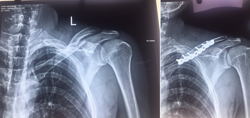 Hình ảnh chụp Xquang xương đòn trái gãy và sau khi đã phẫu thuật cố định xương cho bệnh nhân Hoàng Văn.H (Hình ảnh do bác sỹ Bệnh viện Đa khoa Yên Bình cung cấp)