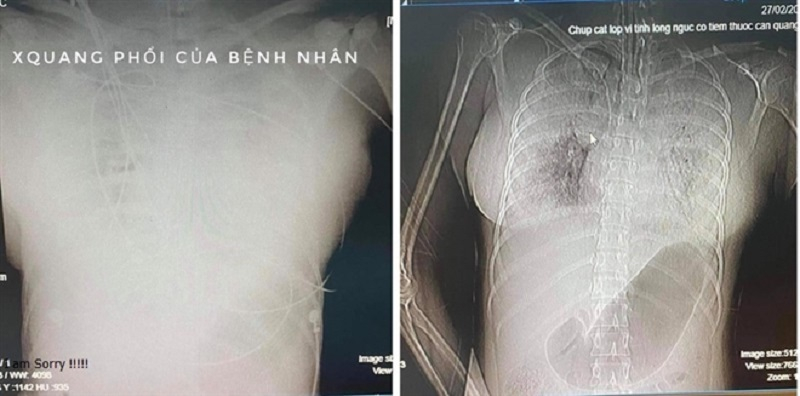 TP. Hồ Chí Minh: Một người phụ nữ chết bất thường sau khi tiêm filler nâng ngực.