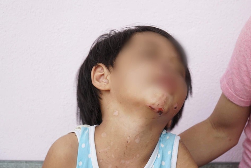 Bé gái 5 tuổi với những vết thương trên người nghi do cha dượng bạo hành. (Ảnh: Dân Trí).