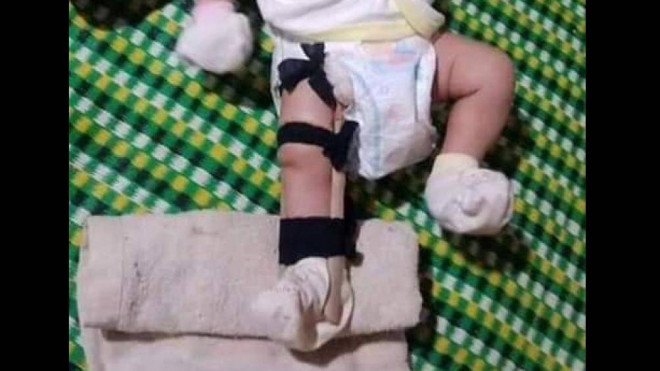 Hình ảnh bé gái 2 tháng tuổi bị bạo hành gãy chân khiến nhiều người xót xa.