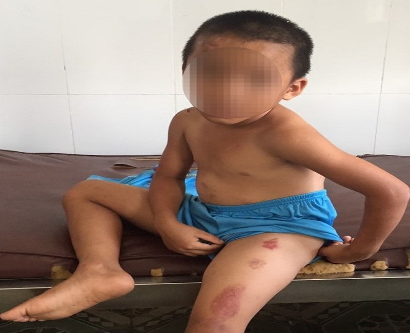 Bé 6 tuổi nghi bị cha dượng bạo hành, dùng dao cắt thịt, dí thuốc lá vào mặt. (Ảnh: Dân Trí).