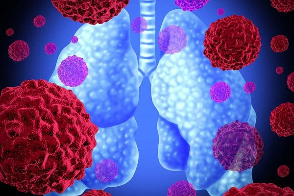 Bộ Y tế khuyến cáo phòng chống bệnh viêm phổi cấp . Ảnh minh họa 