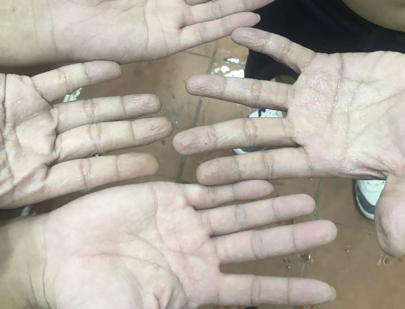 Đôi bàn tay nhiều nhân viên y tế nhăn nheo vì bị ngâm trong mồ hôi cả ngày ẢNH: NVCC