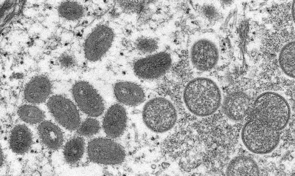  Mỹ xác nhận bệnh nhân đầu tiên lây virus bệnh đậu mùa khỉ từ người mang trùng sang người bệnh.