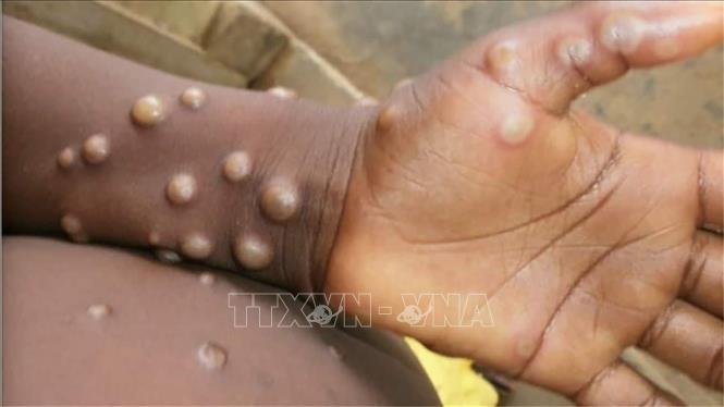  Các phần bị tổn thương xuất hiện trên tay và chân em nhỏ bị nghi mắc bệnh đậu mùa khỉ ở Bondua, Liberia. Ảnh tư liệu: Getty Images/TTXVN