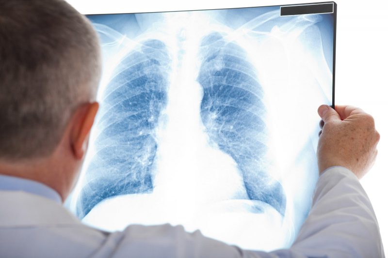 AFB là gì? Cách phòng chống bệnh Lao phổi như thế nào?