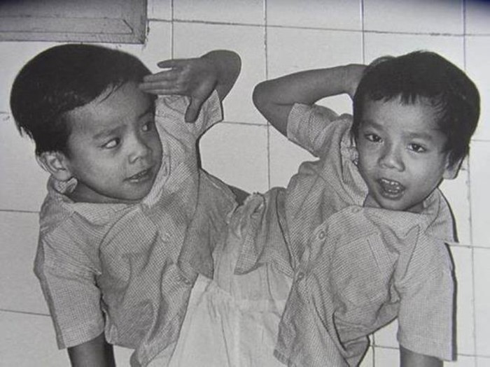 Ca mổ tách rời cặp song sinh dính liền Việt-Đức năm bao nhiêu?