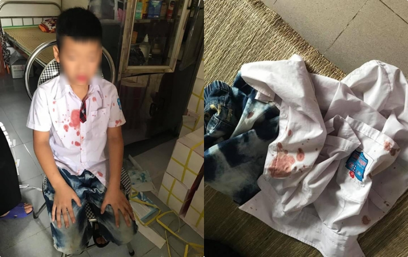 Hiệu trưởng trường Tiểu học Hữu Nghị (TP Hòa Bình, tỉnh Hòa Bình) nơi xảy ra vụ việc phụ huynh đánh học sinh lớp 1 chảy máu đã lên chính thức lên tiếng.