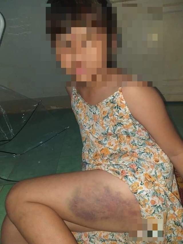 Hình ảnh cháu Đ. bị đánh bầm tím đùi được tài khoản Facebook chia sẻ trên mạng