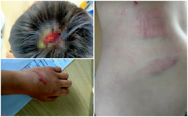 Bé trai 9 tuổi ở Gia Lai nghi bị cha bạo hành dã man phải nhập viện khi trên thân thể, đặc biệt là vùng đầu có nhiều thương tích.