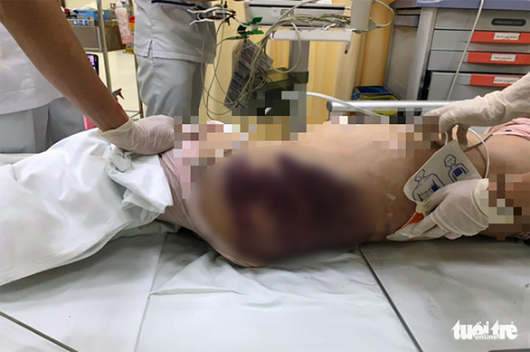 Những vết bầm lớn được xác định xuất hiện trên cơ thể bé gái 8 tuổi khi nhập viện - Ảnh: A.X/ Báo Tuổi trẻ TP HCM
