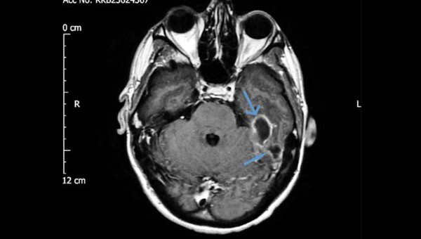 Hình ảnh chụp CT cho thấy vùng nhiễm trùng của người đàn ông