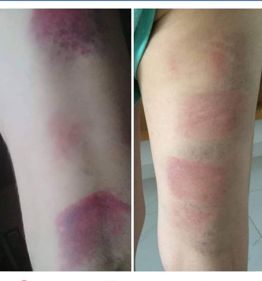 Vết bầm tím của em học sinh được phụ huynh chia sẻ trên mạng xã hội - Ảnh: Ngọc Giang