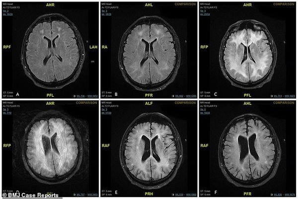 Ảnh chụp MRI cho thấy phần chất trắng trong não người đàn ông bị biến mất dần trong quá trình điều trị.