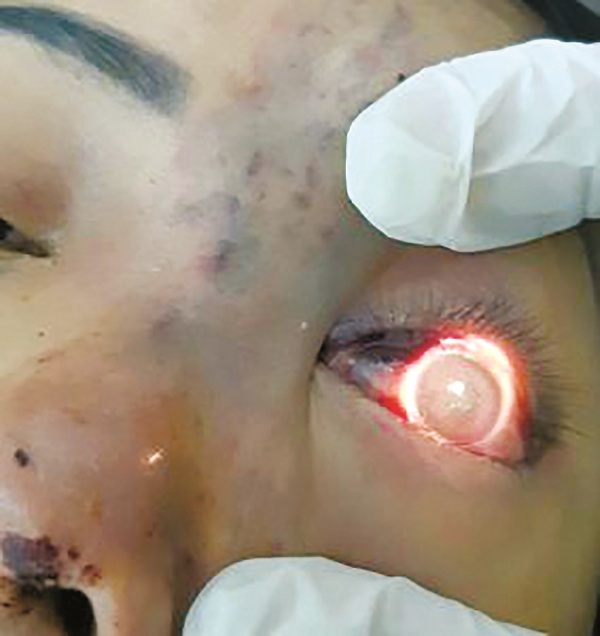 Một bệnh nhân bị mù mắt do tiêm filler.