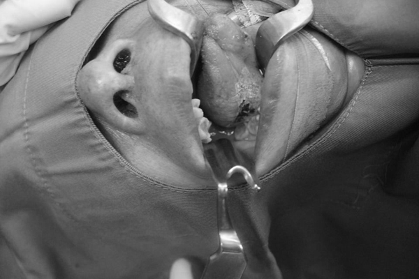 Hình ảnh mảng trắng dày bao phủ dưới lưỡi phải bệnh nhân