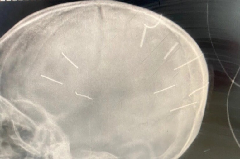 Hình ảnh chụp X-quang hộp sọ bé 3 tuổi ở Hà Nội với nhiều đinh bị gắn trong đầu (Ảnh: BVCC).