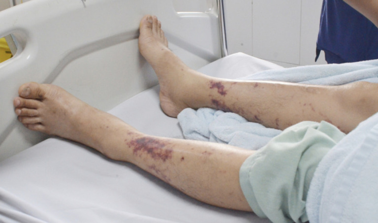 Bệnh nhân nổi vân tím toàn thân, xuất huyết dưới da rải rác do nhiễm liên cầu khuẩn lợn (Ảnh: BSCC)