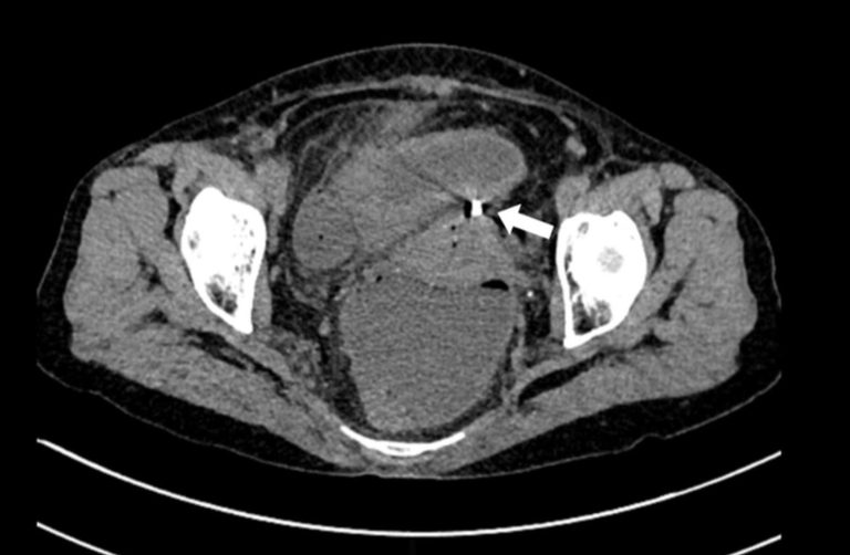Hình ảnh chụp cho thấy dụng cụ tử cung xuyên qua thành tử cung vào ruột. Ảnh: Bệnh viện cung cấp