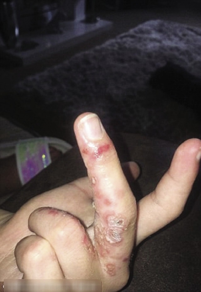 Một trường hợp có nguy cơ tháo đốt ngón tay do chơi slime.