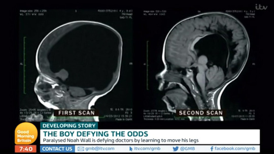 Hình ảnh đầu tiên chụp chiếc đầu hầu như không não của cậu bé, khi bé sắp ra đời và hình ảnh quét não khi bé được 3 tuổi - ảnh: Good Morning Britain    