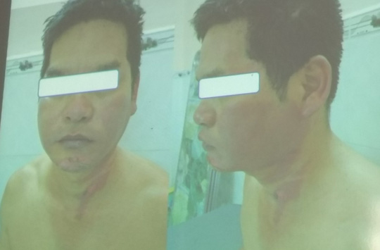 Da mặt, cổ của bệnh nhân bị lột ra nhiều mảng lớn - Ảnh do bệnh viện cung cấp    