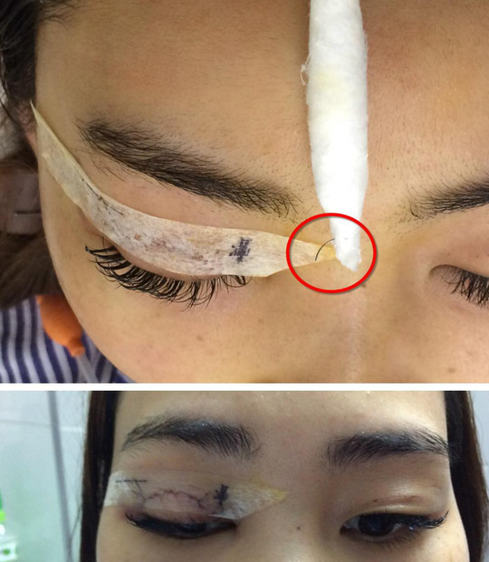 Cô gái bị kim khâu chui vào mắt trong lúc nhấn mí - Ảnh do bác sĩ cung cấp