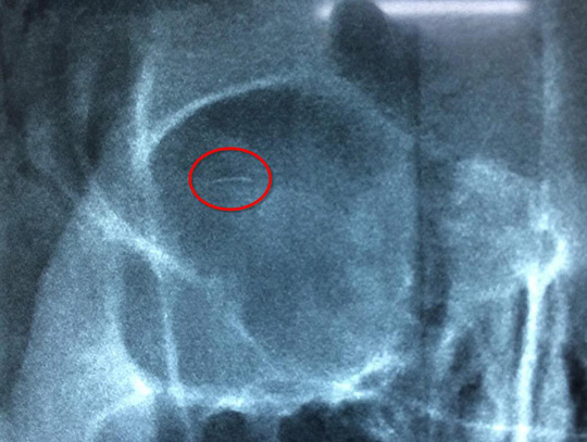 Kết quả phim chụp X-quang cho thấy trong mắt cô gái có hình ảnh lờ mờ một cây kim