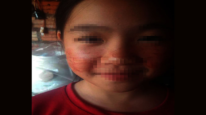 Bé gái 11 tuổi ở Gia Lai mắc căn bệnh 
