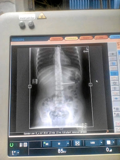 Hình ảnh chụp X-quang cho thấy chiếc kim nằm trong dạ dày nạn nhân. (Ảnh: Timeslive)