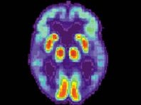Các nhà khoa học cho rằng có những thay đổi chuyển hóa nhất định liên quan đến căn bệnh Alzheimer - Ảnh : Wikimedia Commons
