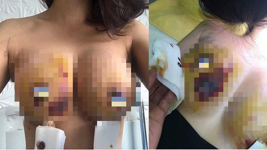 Ngực chị L sưng tấy, có dấu hiệu hoại tử sau khi thực hiện phẫu thuật tại thẩm mỹ viện Kim Cương. Ảnh: vietnamnet