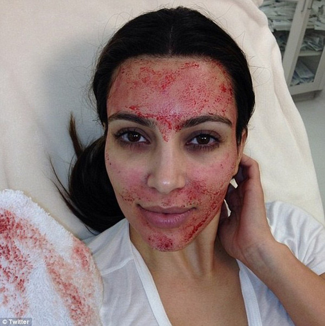 Kim Kardashian gây sốc với gương mặt be bét máu khi đi làm đẹp