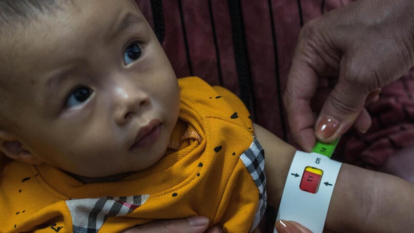 Một trẻ em suy dinh dưỡng cấp tính nặng, hình ảnh do UNICEF tại Việt Nam cung cấp.