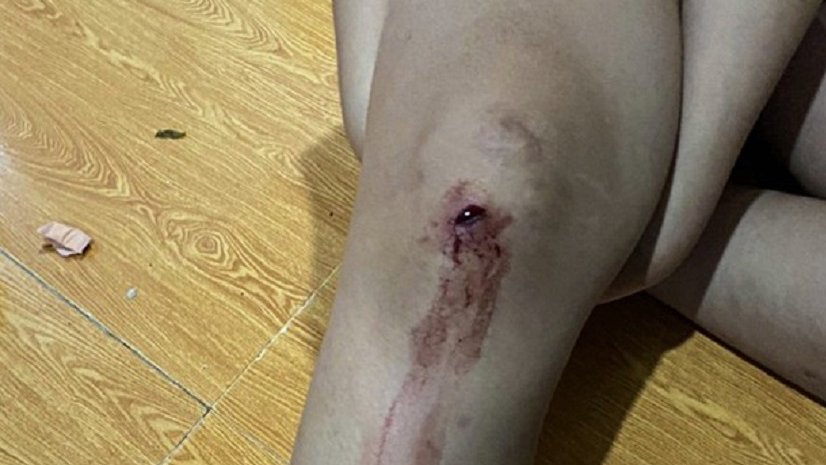 Vết thương ở chân của 2 nạn nhân khị các đối tượng nổ súng bắn