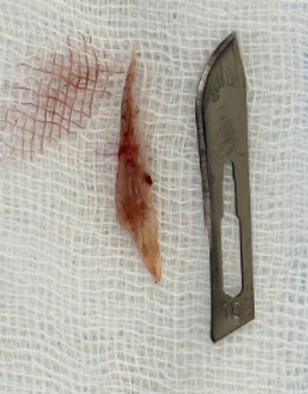 Chiếc xương cá đâm thủng động mạch chủ bệnh nhân, một trường hợp hiếm gặp