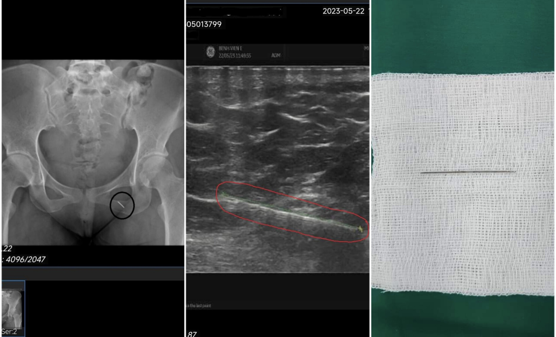 Chiếc kim khâu 5cm qua hình chụp 3D và sau khi được lấy khỏi cơ mông của bệnh nhân (Ảnh BVCC)