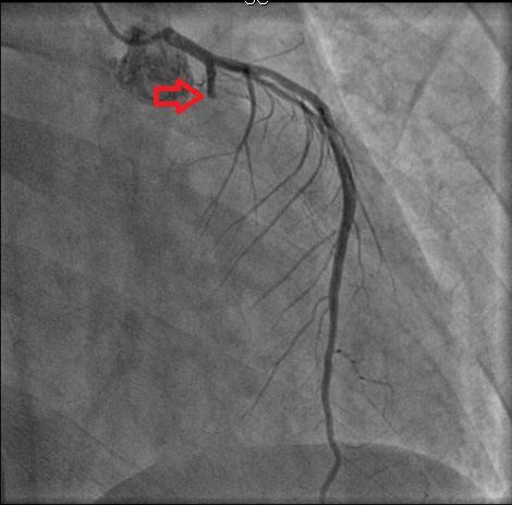 Hình ảnh chụp mạch vành trước khi đặt stent cho thấy nhánh mũ tắc hoàn toàn từ LCX1. Ảnh: BVCC.