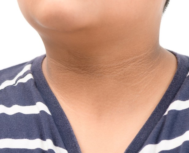 Xuất hiện vùng da tối ở nách hoặc cổ: Những khu vực dễ có nếp gấp như dưới nách, cổ mà xuất hiện mảng màu nâu vàng, hơi sưng thì đó là biểu hiện của tình trạng kháng insulin (cơ thể không phản ứng với insulin). Ngoài ra, đây cũng là dấu hiệu của bệnh tiểu đường loại 2.