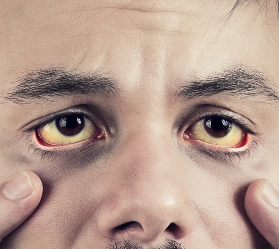 Vàng da, tròng mắt trắng: Đây là biểu hiện phổ biến cảnh báo các vấn đề sức khỏe ở vùng gan. Da và mắt có màu sắc bất thường như vậy là do có chất hóa học bilirubin tích tụ trong máu. Khi gặp những dấu hiệu bất thường trên, bạn sẽ cần đi gặp bác sĩ ngay để có thể chẩn đoán sớm và kịp thời chữa trị.