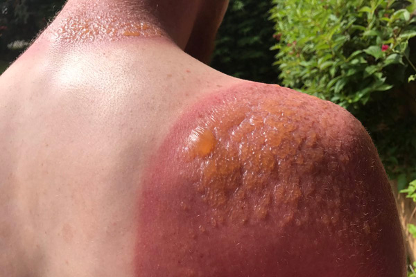 Cháy nắng có thể gây tổn thương nghiêm trọng cho da.