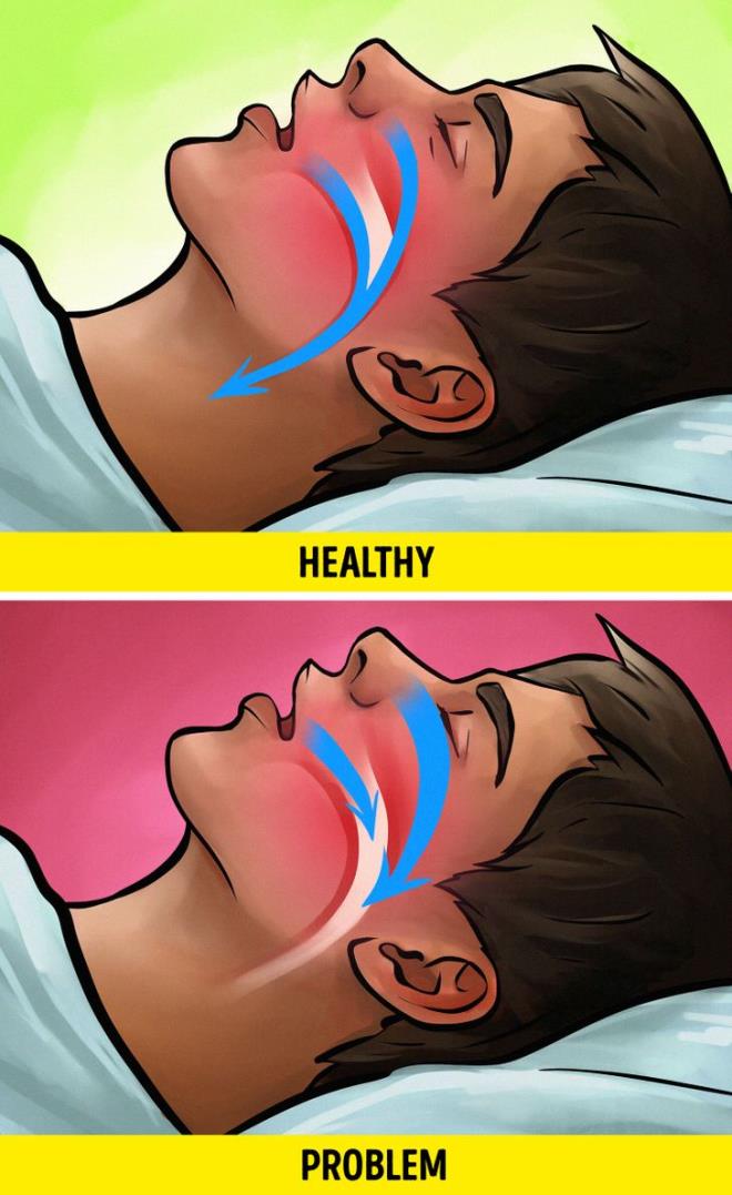 Tắc nghẽn hô hấp, ngưng thở khi ngủ: Ngưng thở hay tắc nghẽn hô hấp là những vấn đề khá nghiêm trọng. Người gặp tình huống này thường bị tỉnh giấc và có giấc ngủ không sâu. Đây là lý do tại sao họ thường có xu hướng ngủ nhiều hơn người bình thường.