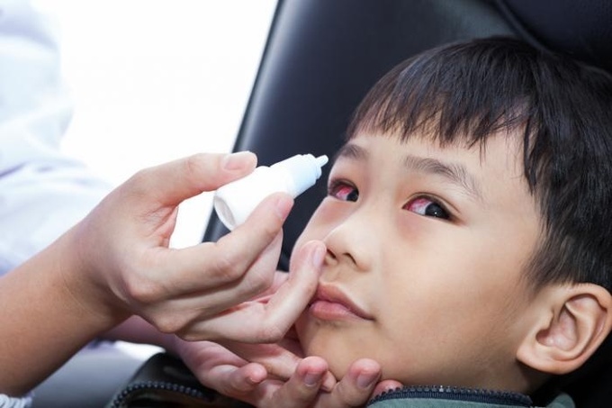 Dùng nước nhỏ mắt nhân tạo là giải pháp giúp giảm bớt tình trạng khô mắt ở trẻ. Ảnh: Alamy.