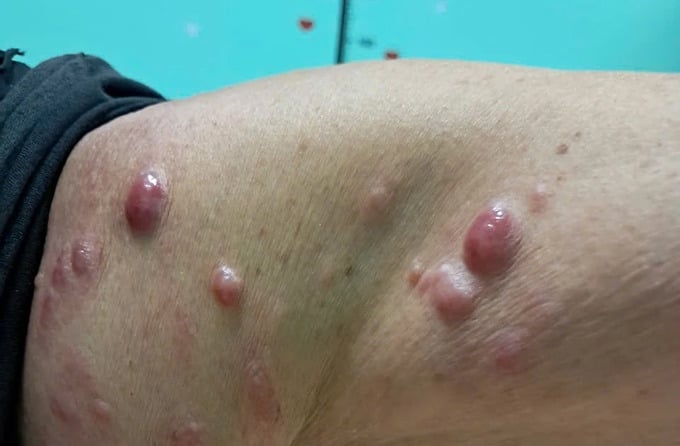 Các sẩn cục nổi dưới da bệnh nhân - Ảnh BVCC