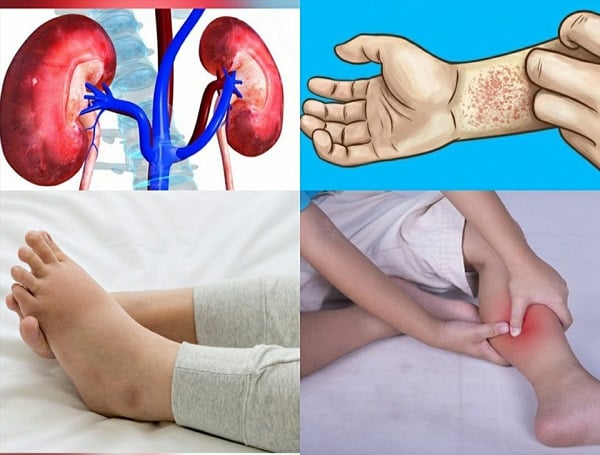 Dấu hiệu cảnh báo tổn thương thận