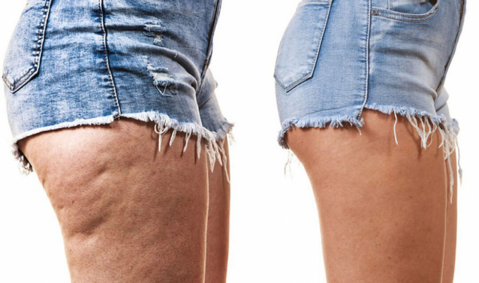 Làn da sần như vỏ cam xuất hiện quanh vùng đùi hoặc hai bên hông là dấu hiệu của cellulite (Ảnh: Flickr)