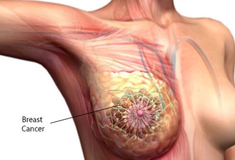  Có nhiều nguyên nhân gây ra căn bệnh ung thư vú - Ảnh minh họa: Internet