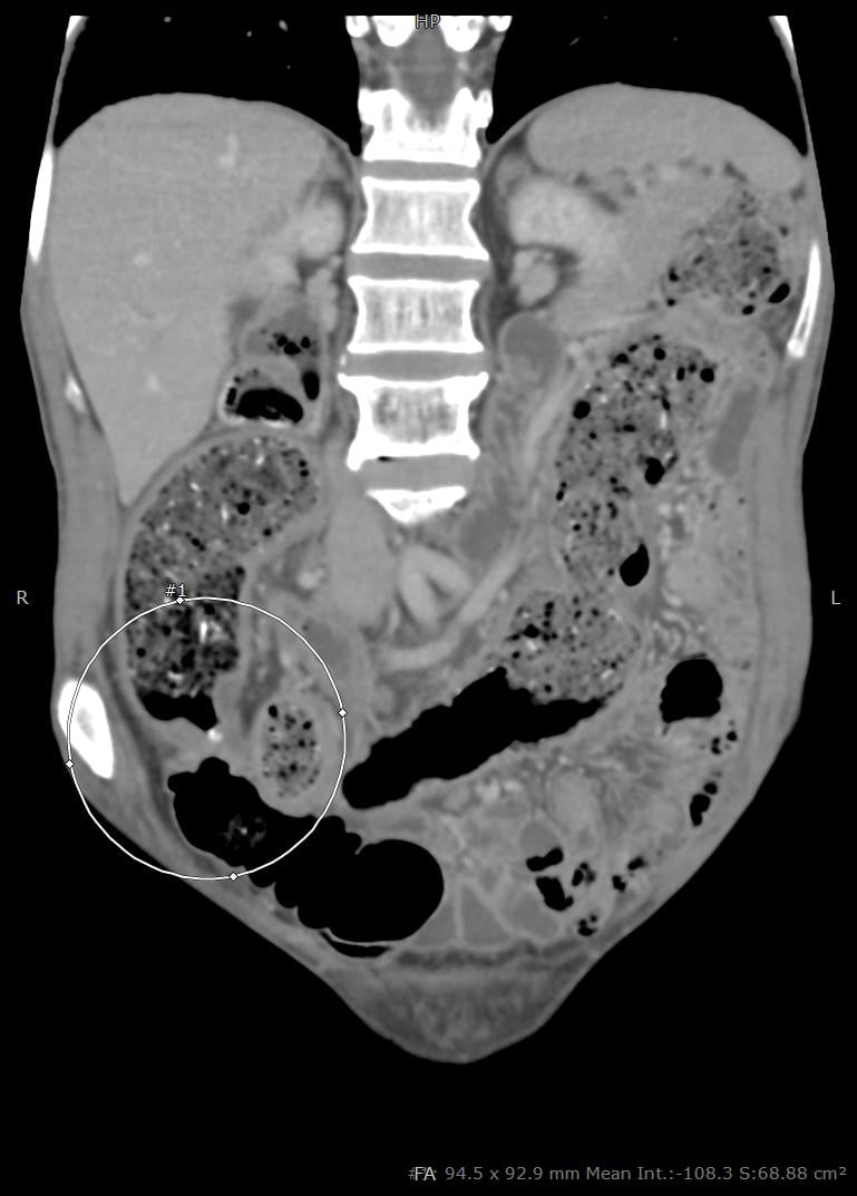  Ảnh chụp CT cho thấy người bệnh có khối u đại tràng trái - Ảnh: BVCC